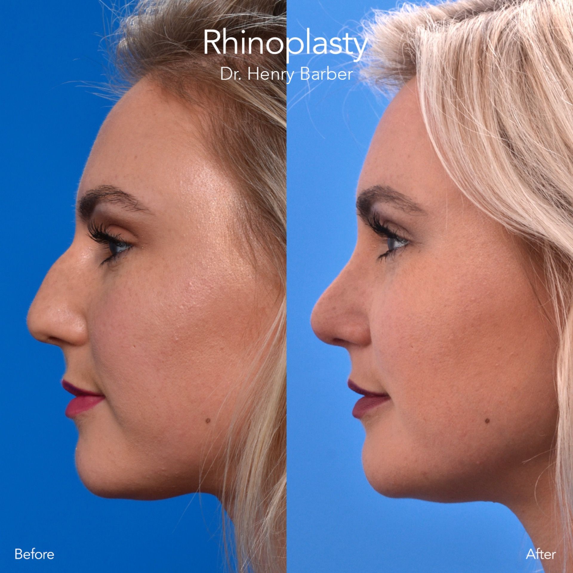 client at barber facial plastic surgery before and after rhinoplasty - mobile al henry barber