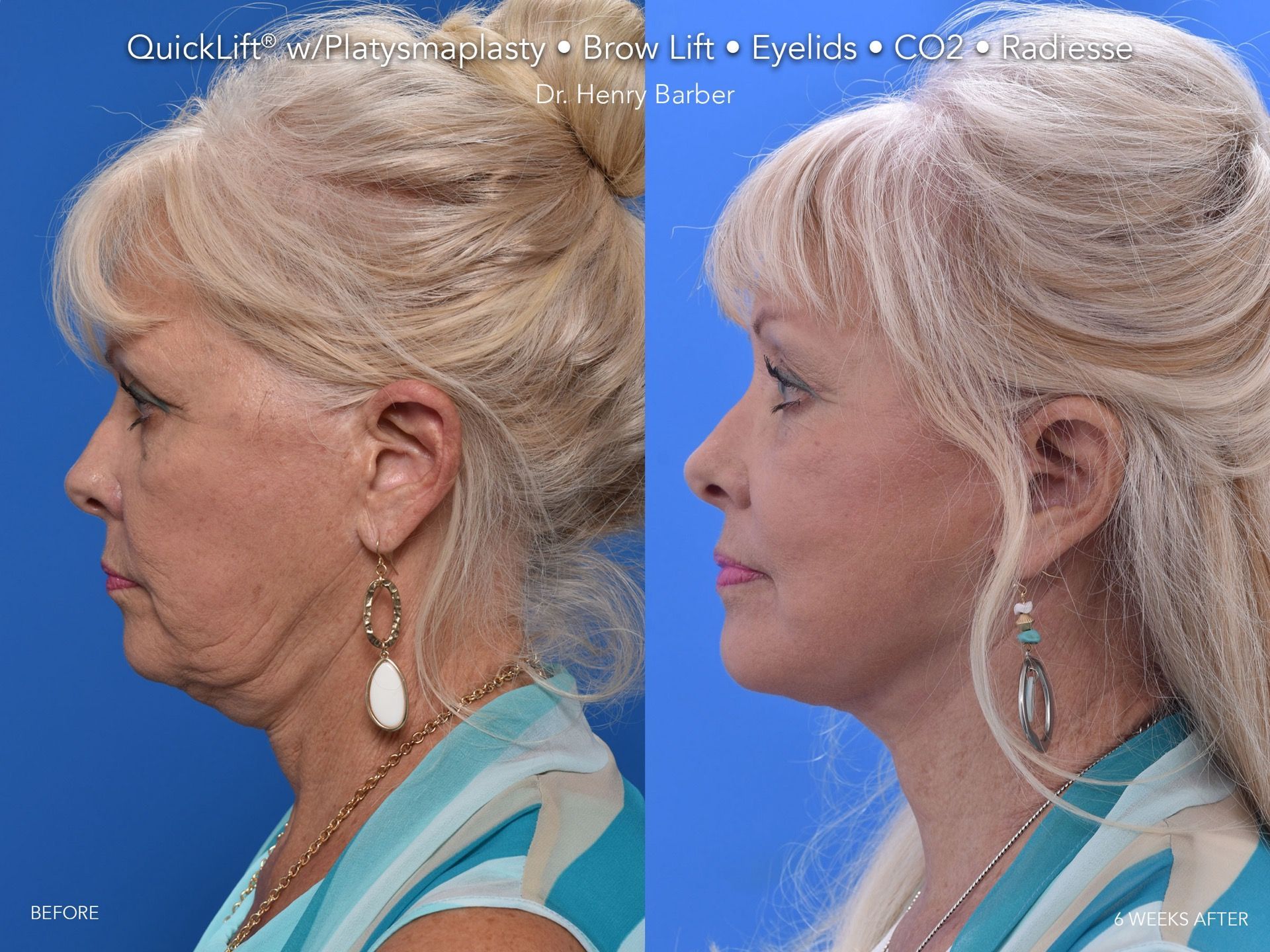 client at barber facial plastic surgery before and after quicklift  - mobile al henry barber
