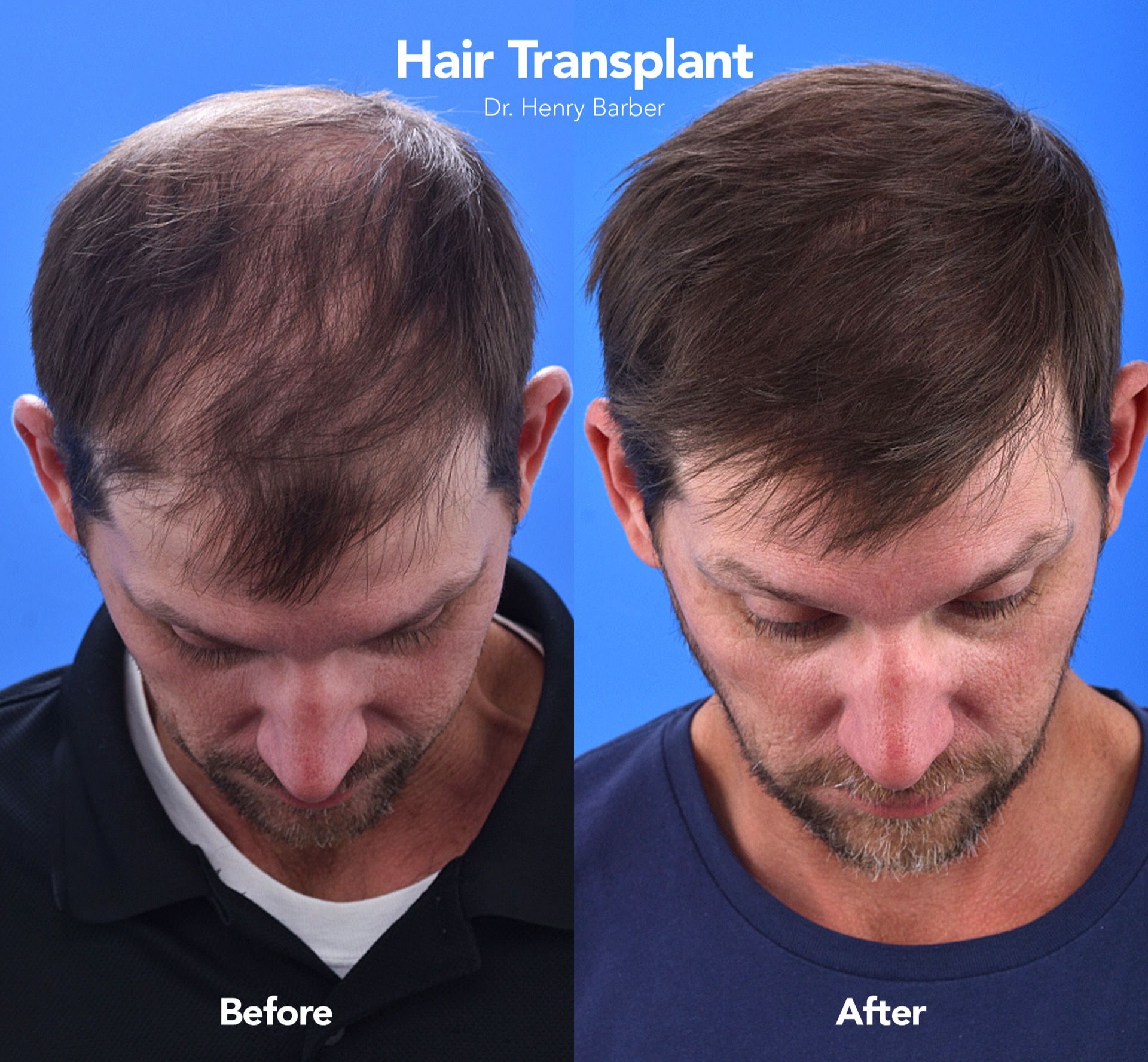 client at barber facial plastic surgery before and after - mobile al henry barber hair transplant 