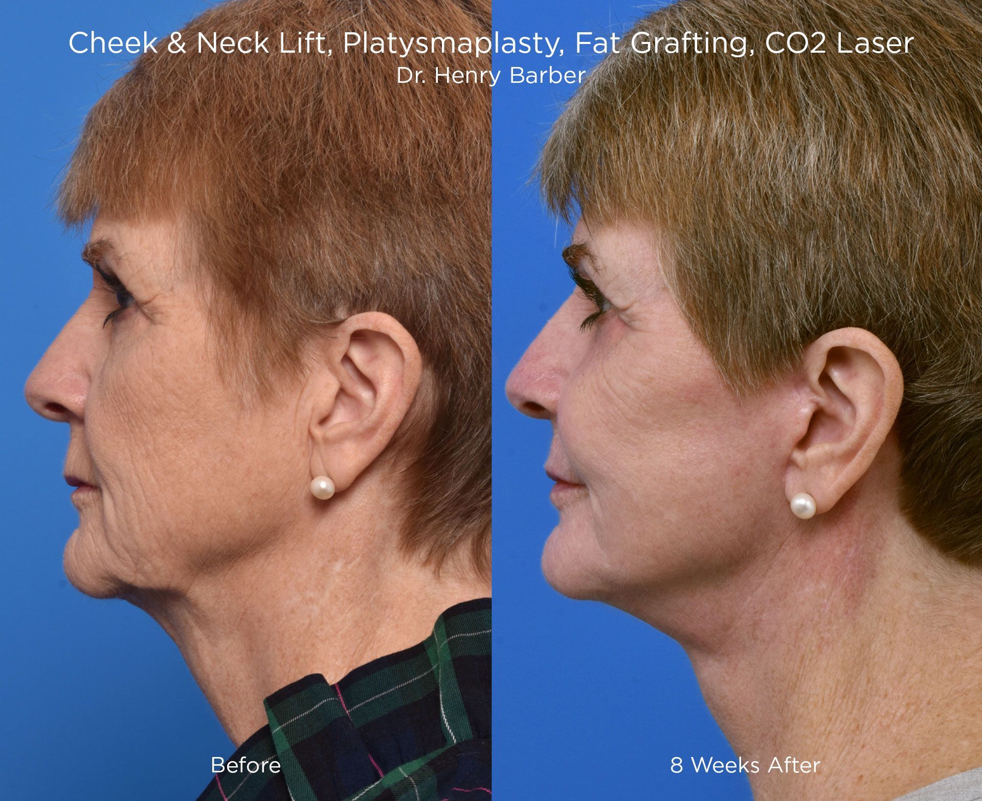 client at barber facial plastic surgery before and after cheek and neck - mobile al henry barber