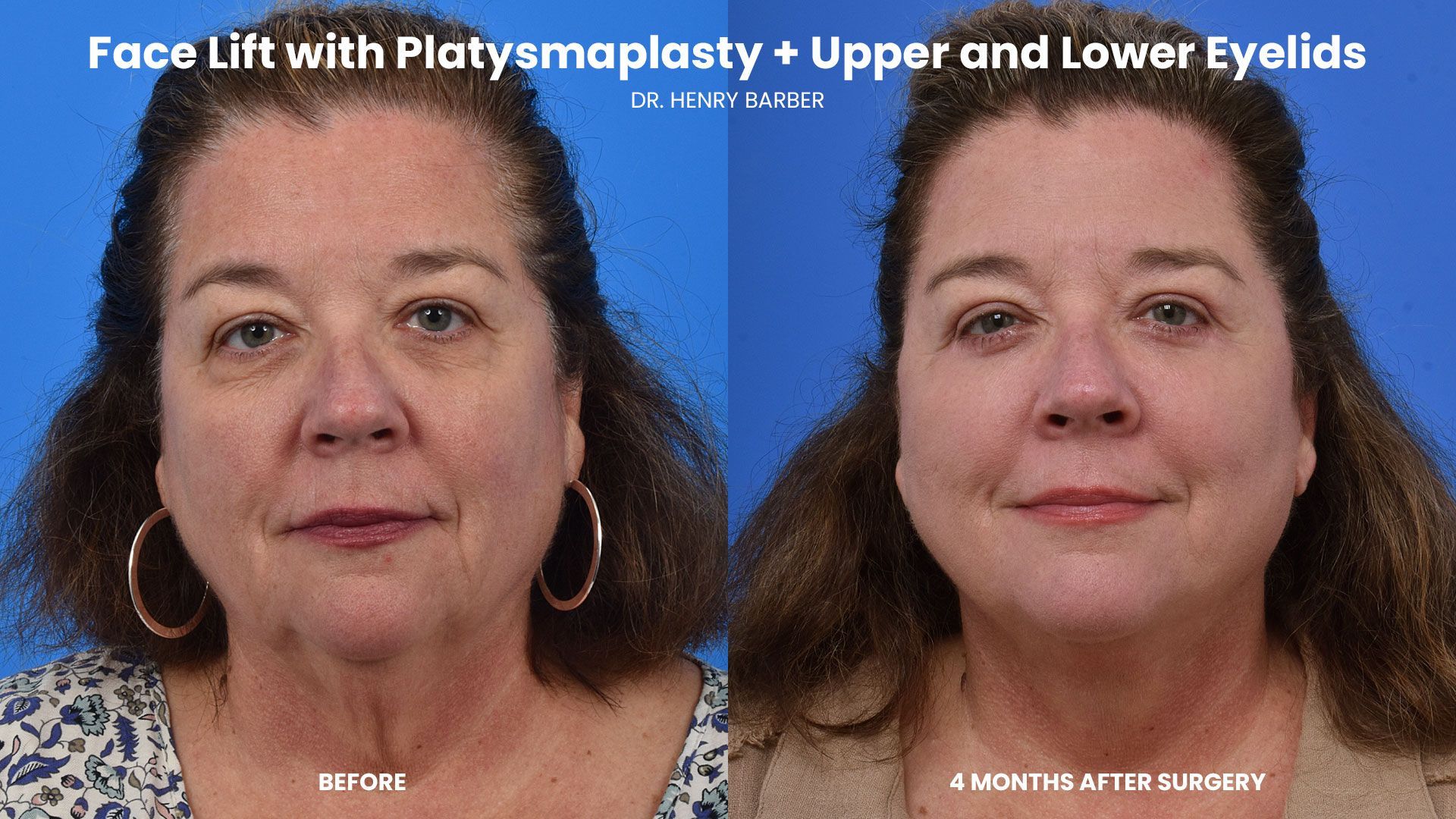 client at barber facial plastic surgery before and after face lift - mobile al henry barber