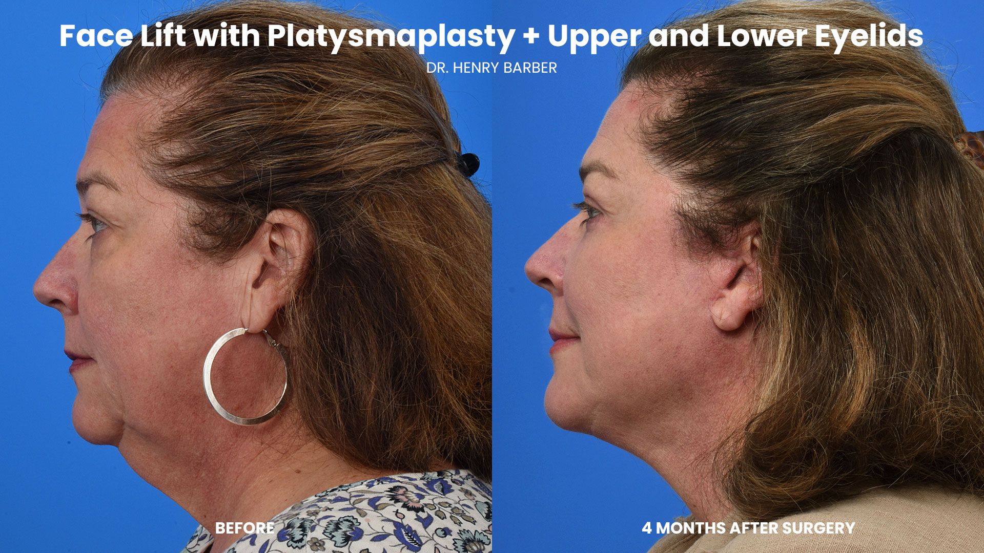 client at barber facial plastic surgery before and after face lift - mobile al henry barber