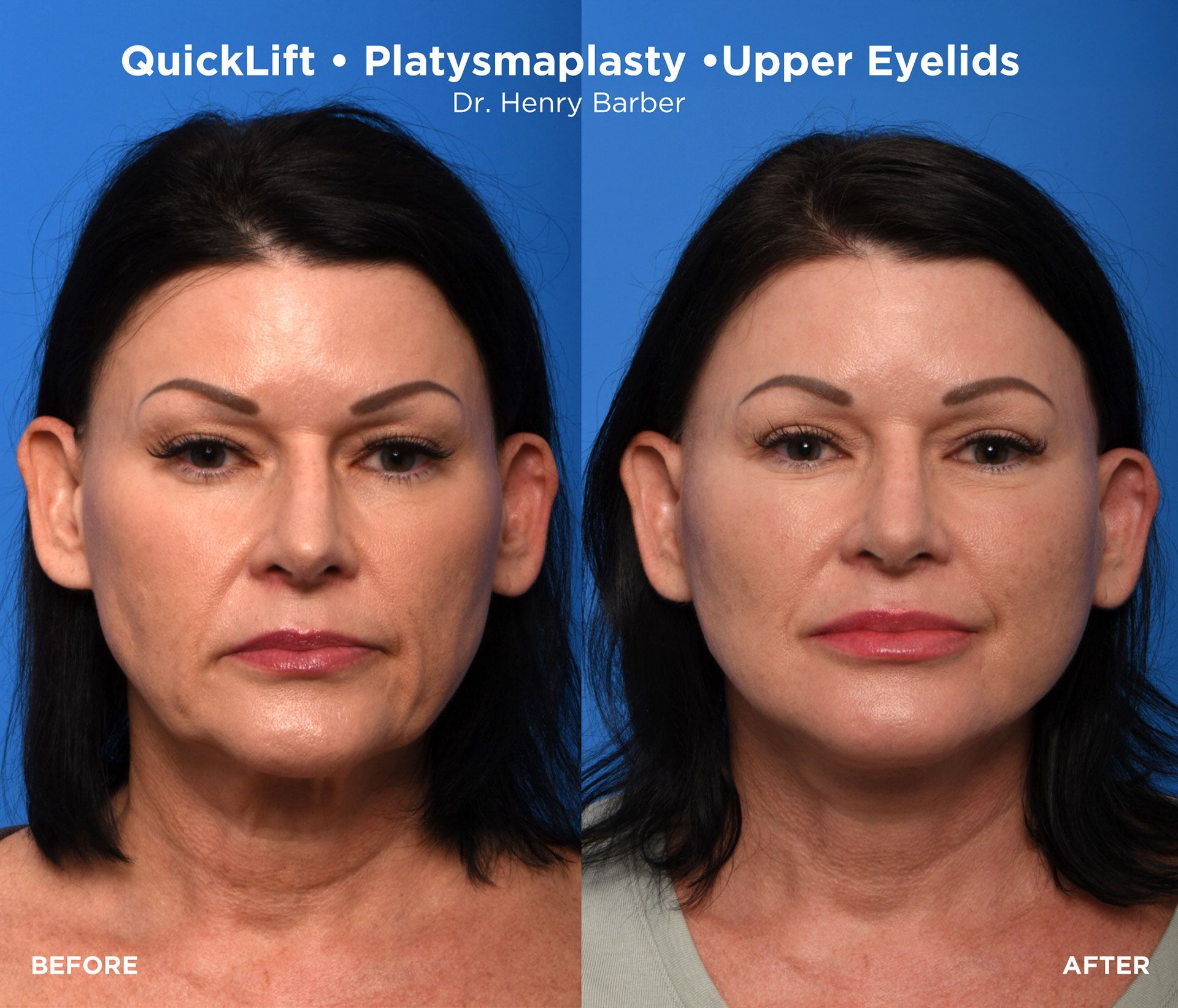 client at barber facial plastic surgery before and after quicklift - mobile al henry barber