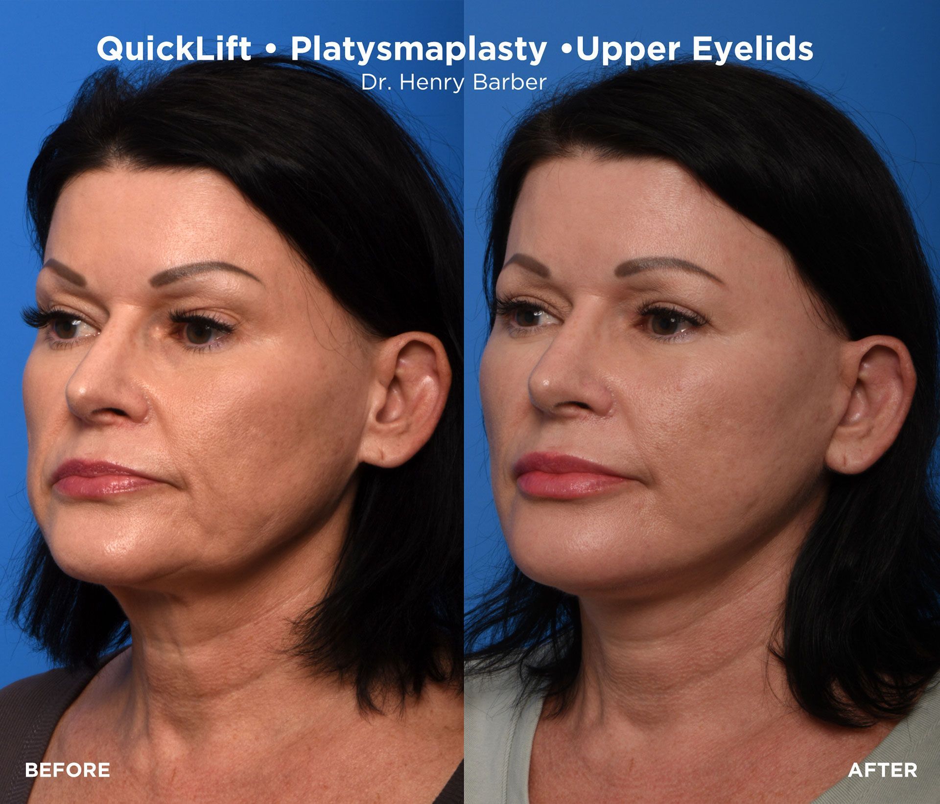 client at barber facial plastic surgery before and after quicklift - mobile al henry barber