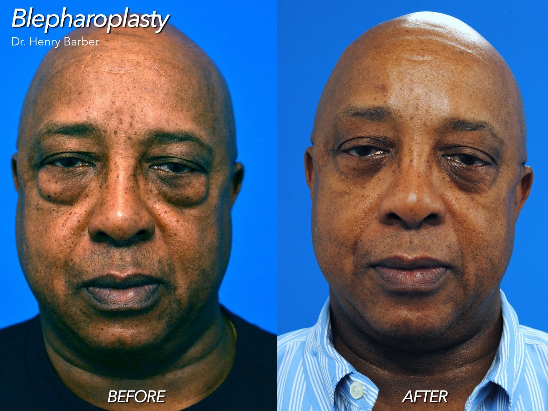 patient at barber facial plastic surgery before and after eyelid surgery