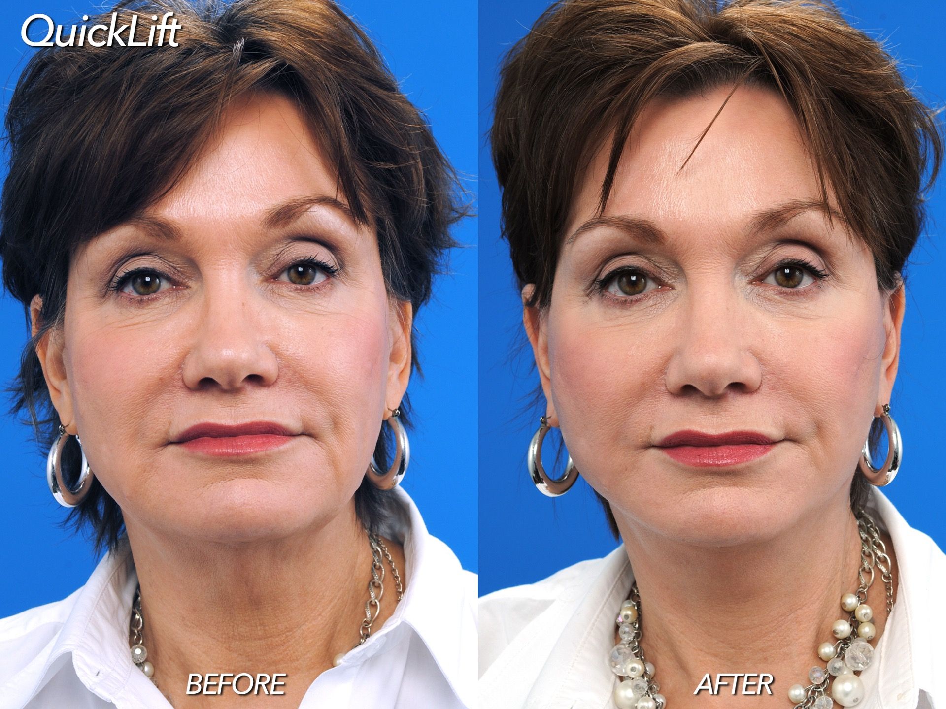 patient at barber facial plastic surgery before and after QuickLift mini facelift - mobile fairhope AL