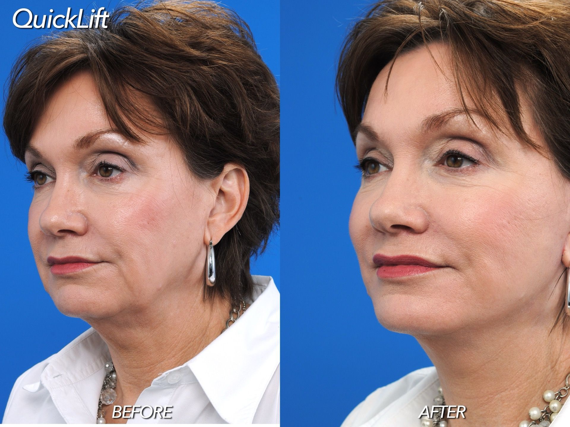 patient at barber facial plastic surgery before and after QuickLift mini facelift - mobile fairhope AL