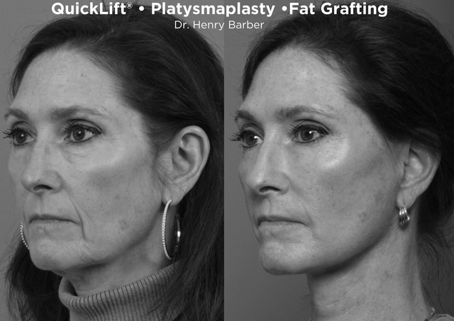 before and after quicklift - barber facial plastic surgery