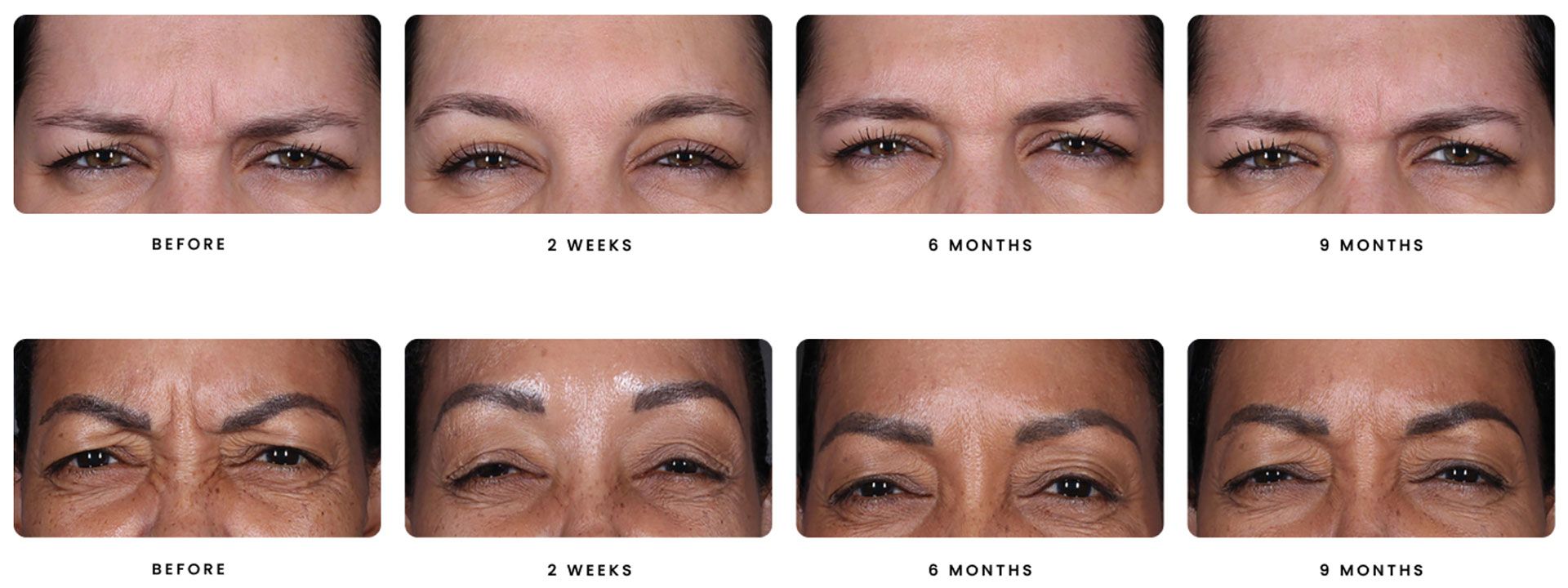 patient before and after DAXXIFY injectable 