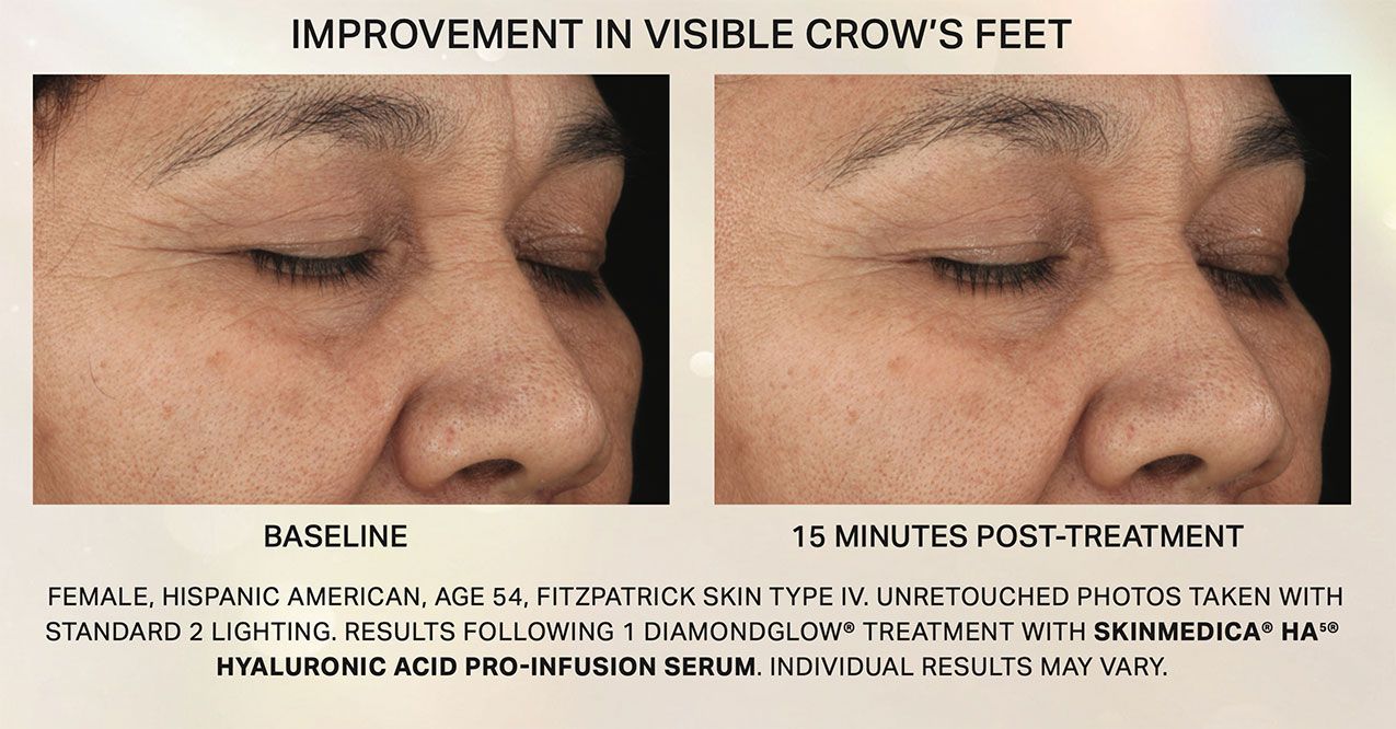 DIAMOND glow facial before and after  for crow's feet