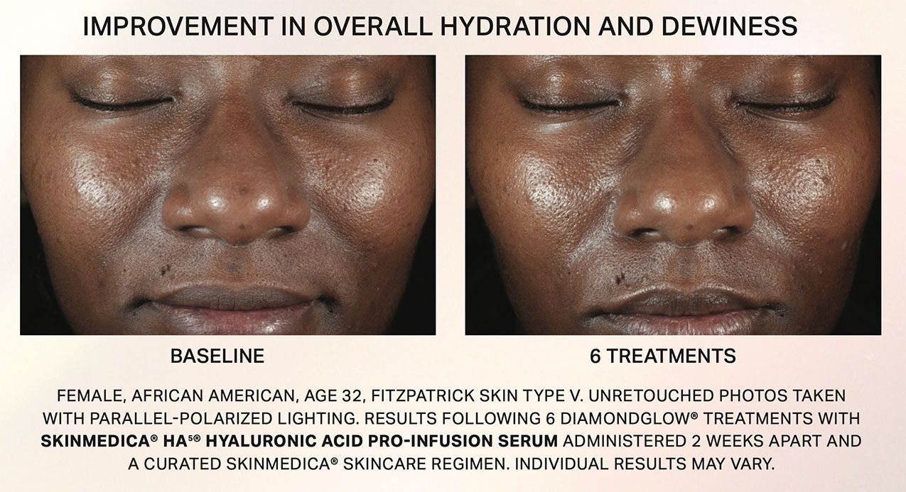 DIAMOND glow facial before and after  6 treatments - smooth skin