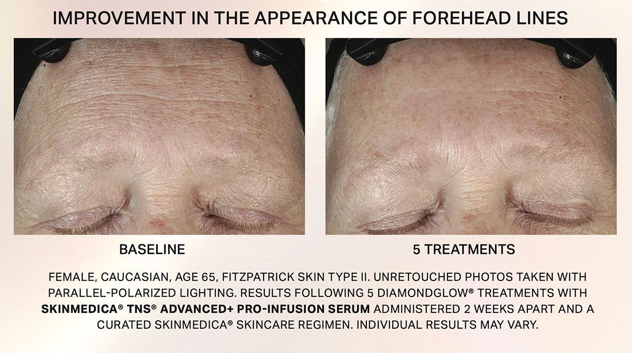 DIAMOND glow facial before and after  5 treatments - smooth skin