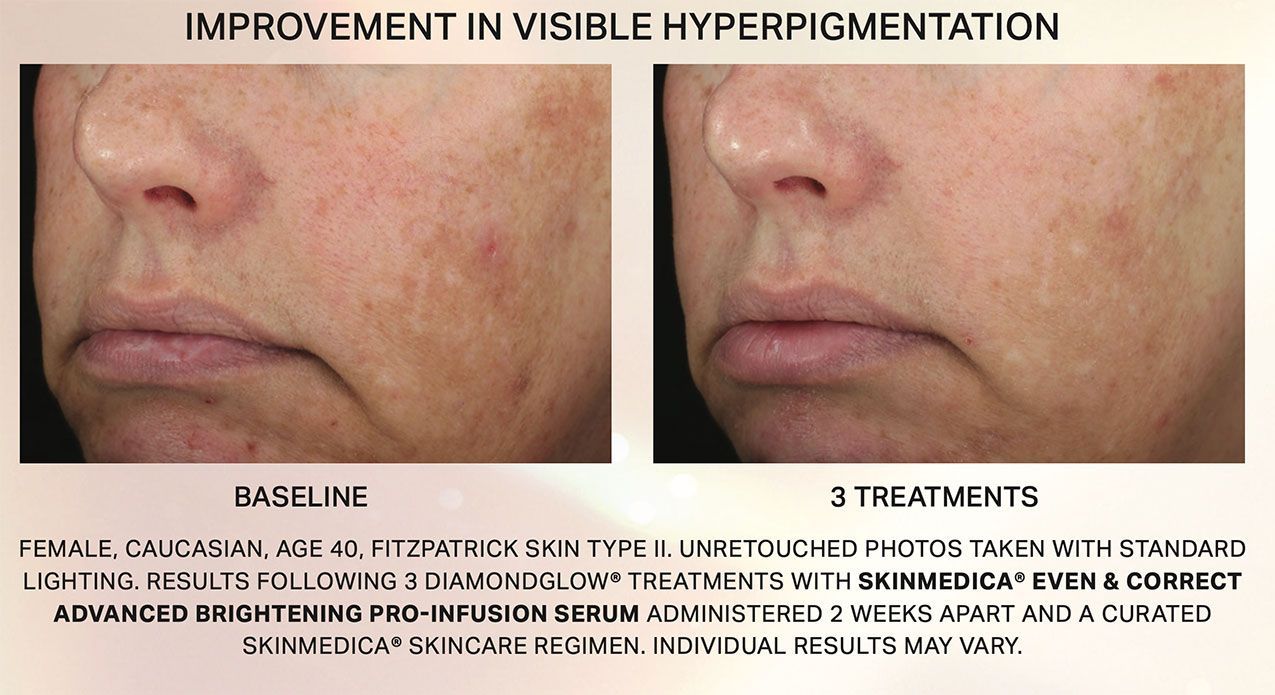 DIAMOND glow facial before and after  for hyperpigmentation