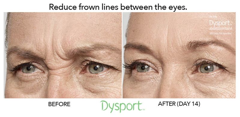 patient before and after dysport for frown lines between eyes