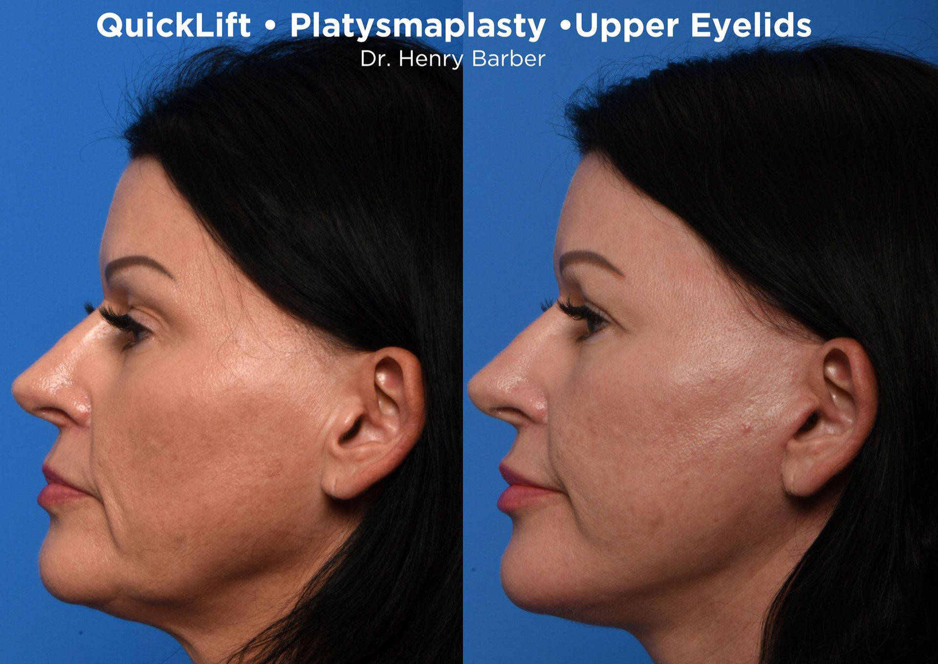 client at barber facial plastic surgery before and after quicklift - mobile al henry barber