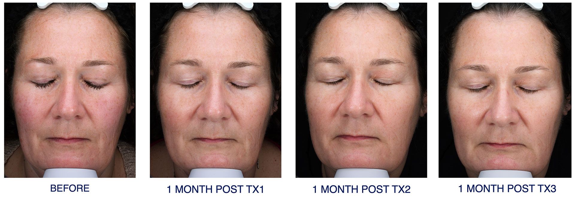 Glacial® RX Cryofacial before and after photos
