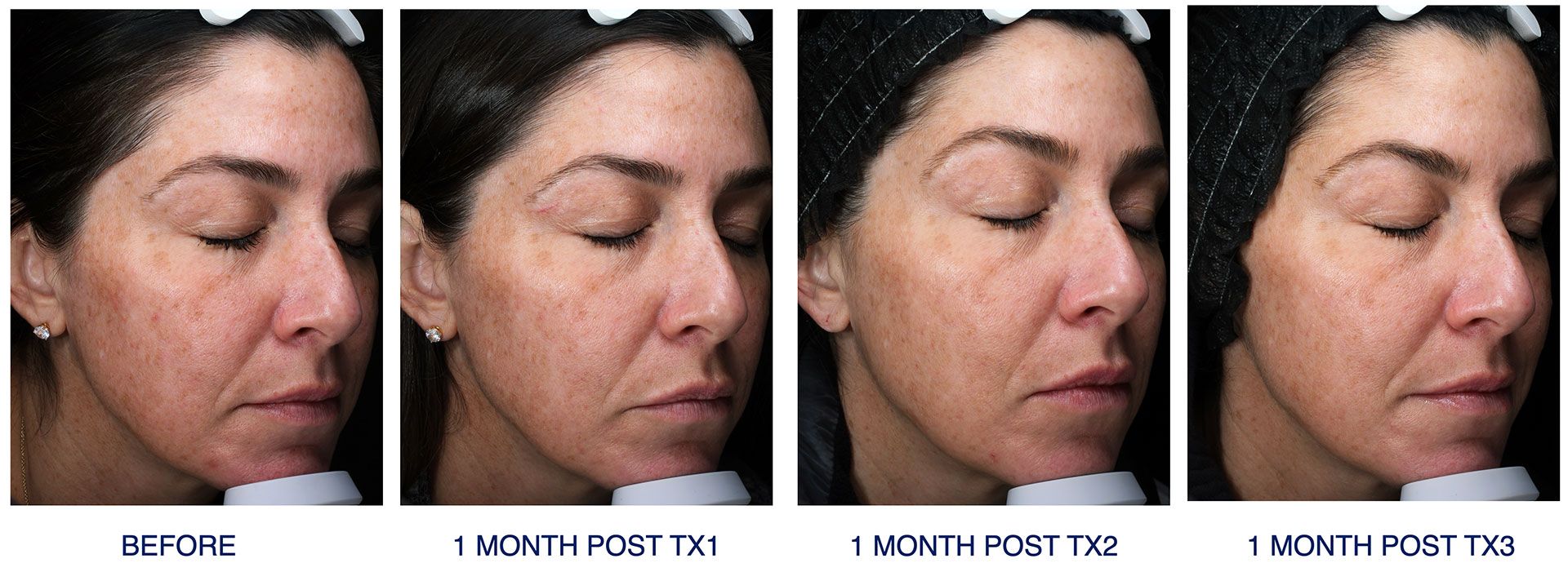 Glacial® RX Cryofacial before and after photos