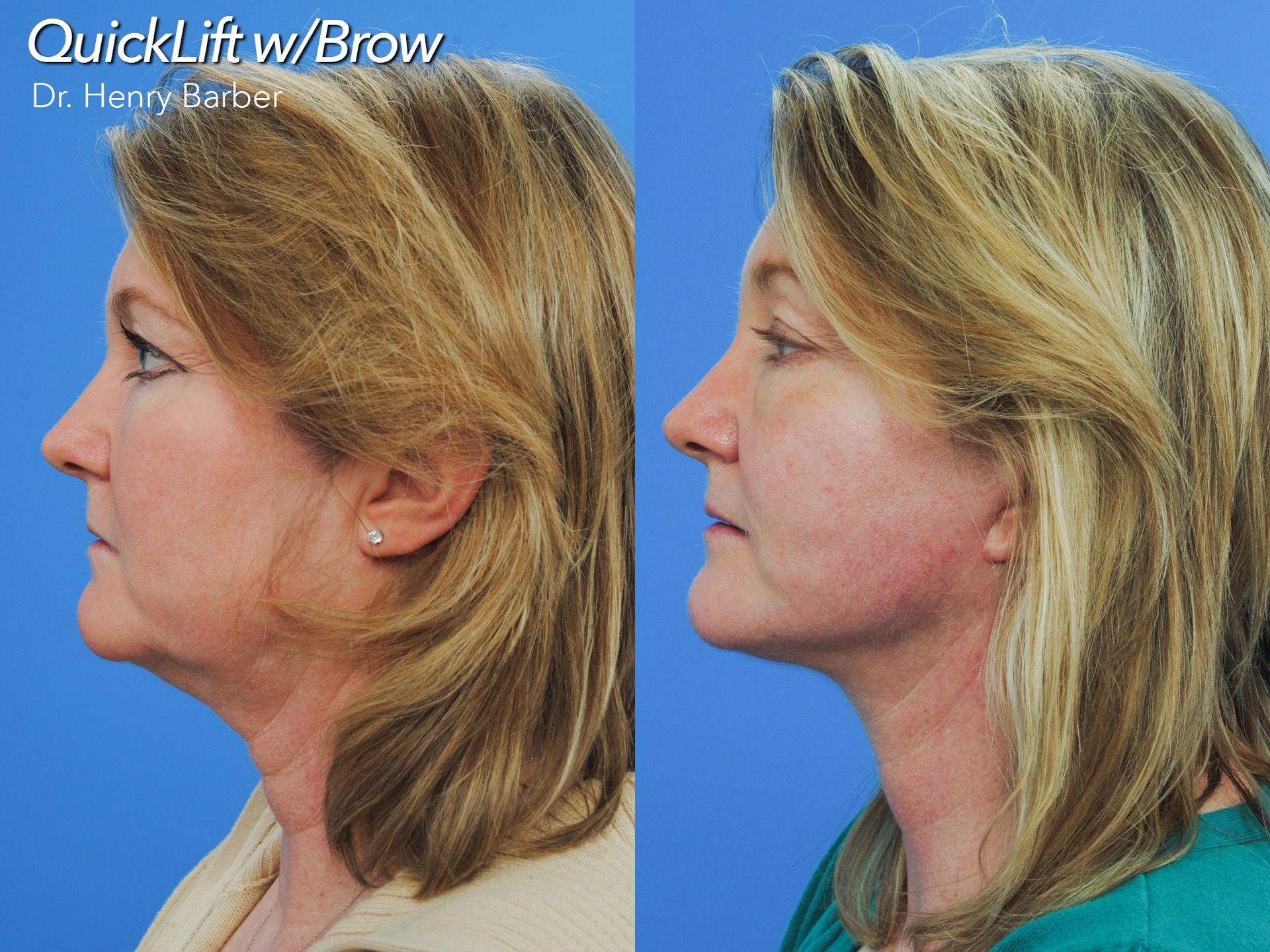 patient at barber facial plastic surgery before and after brow lift - mobile alabama