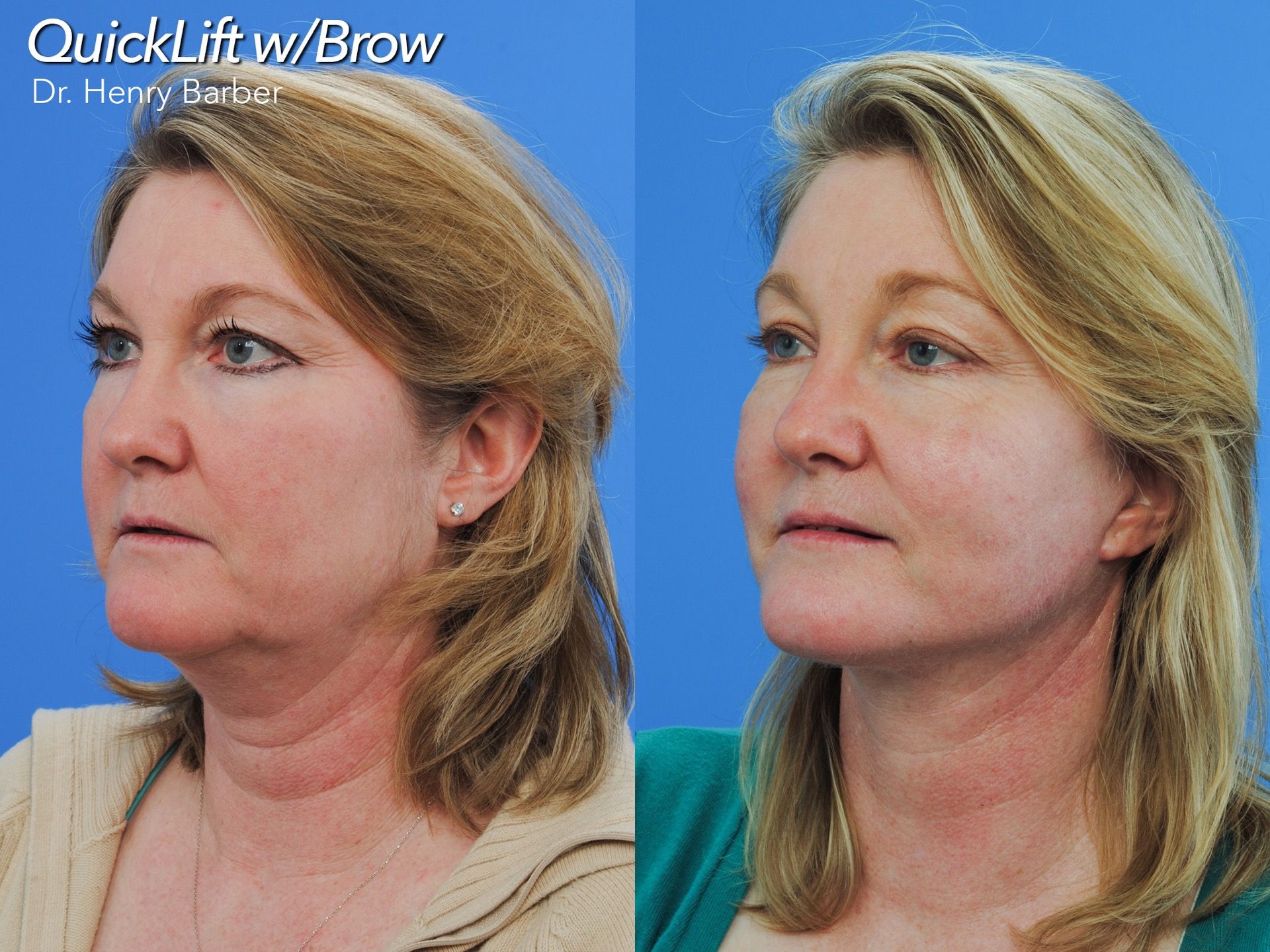 patient at barber facial plastic surgery before and after brow lift - mobile alabama
