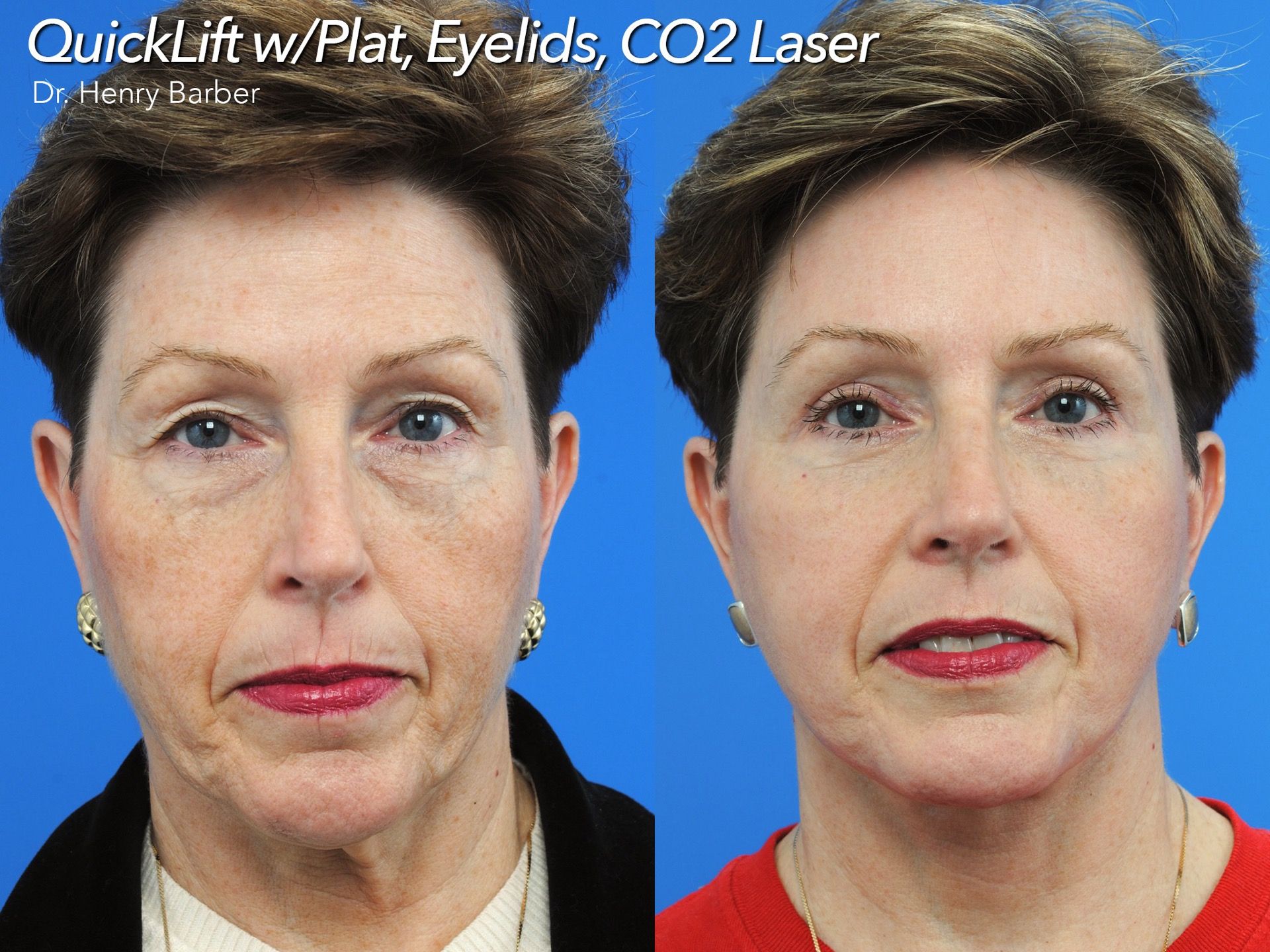 client at barber facial plastic surgery before and after quicklift  - mobile al henry barber