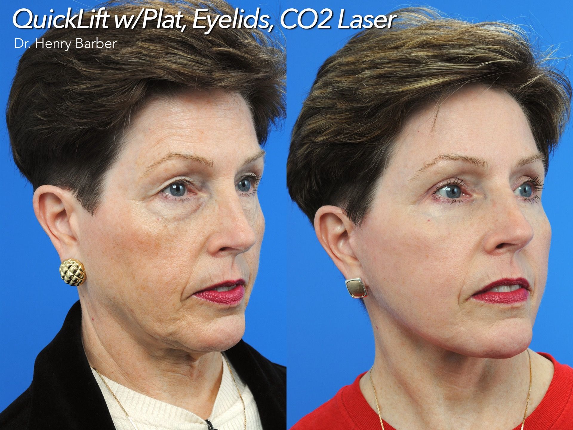 client at barber facial plastic surgery before and after quicklift  - mobile al henry barber