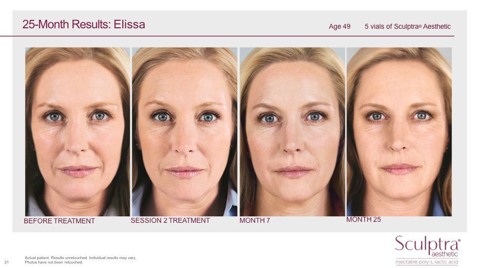 sculptra before and after patient photos