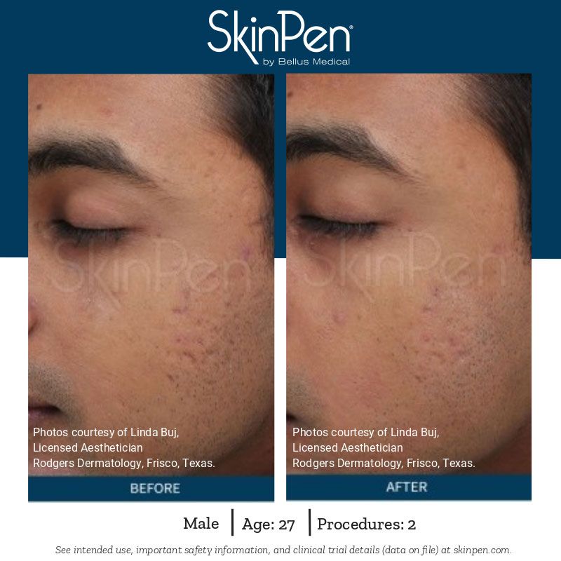 patient before and after skinpen microneedling treatment 