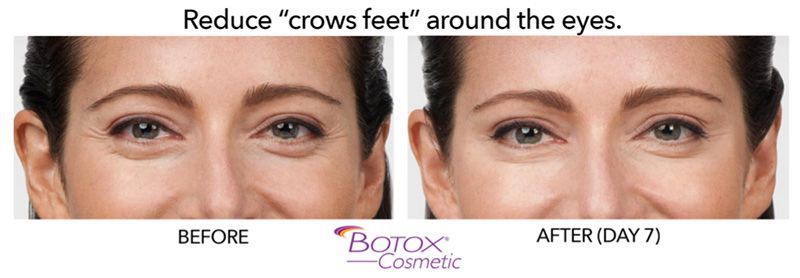 patient before and after botox cosmetic for crows feet around eyes