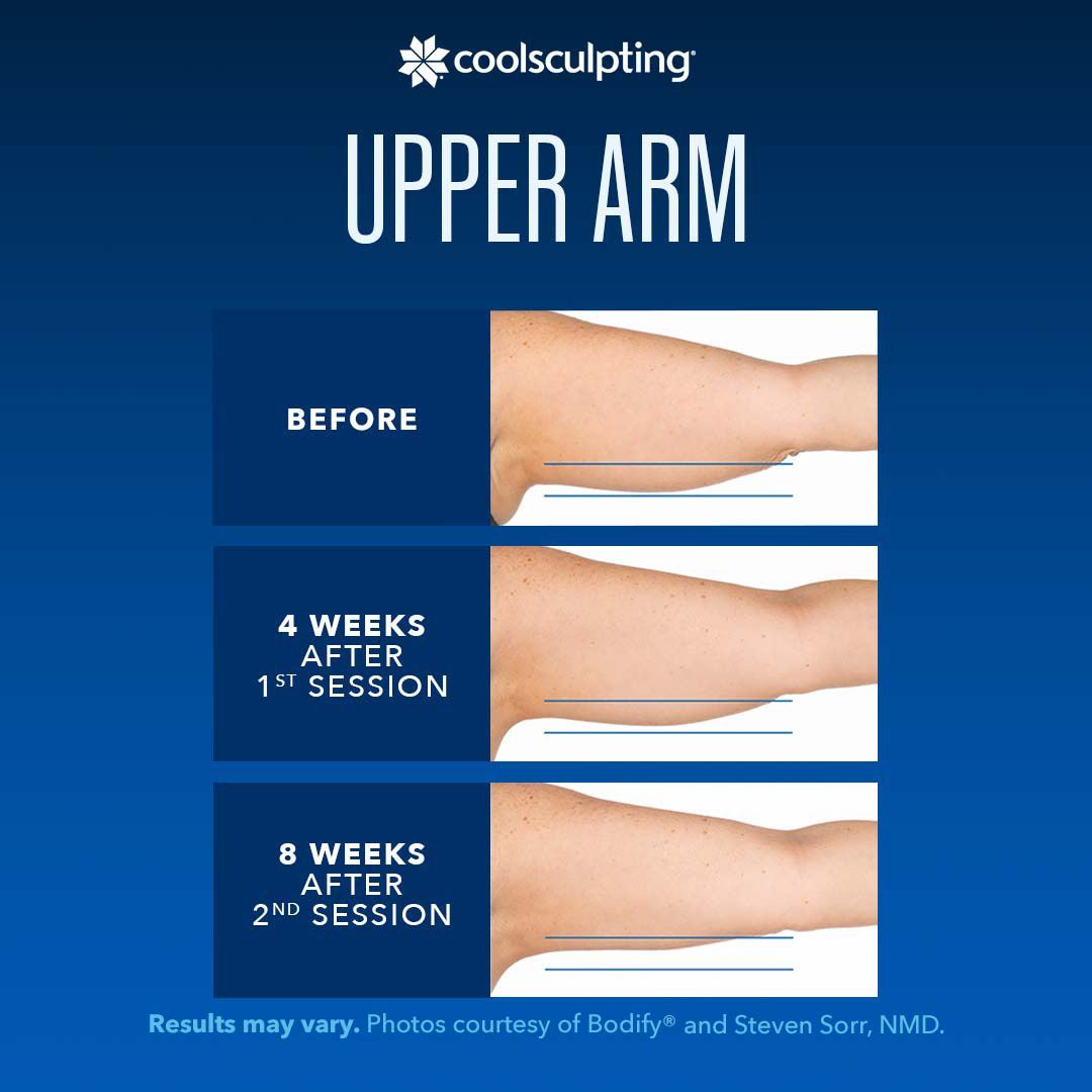 coolsculpting before and after for upper arm