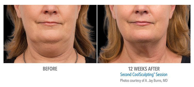 coolsculpting before and after for double chin