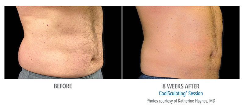 coolsculpting before and after for male abdomen