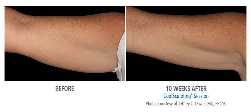 coolsculpting before and after for arm