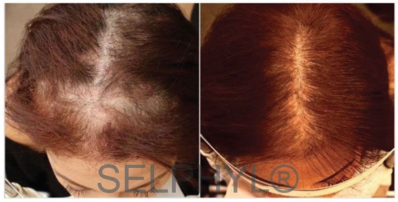 patient before and after selphyl hair restoration treatment mobile al