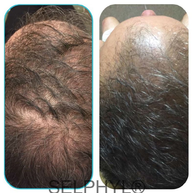 patient before and after selphyl hair restoration treatment mobile al