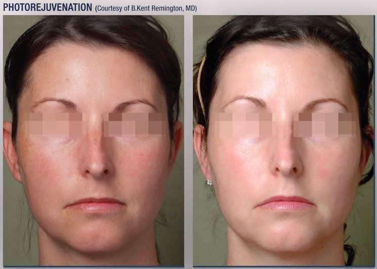 patient at barber facial plastic surgery before and after photofractional laser treatment for photorejuvenation