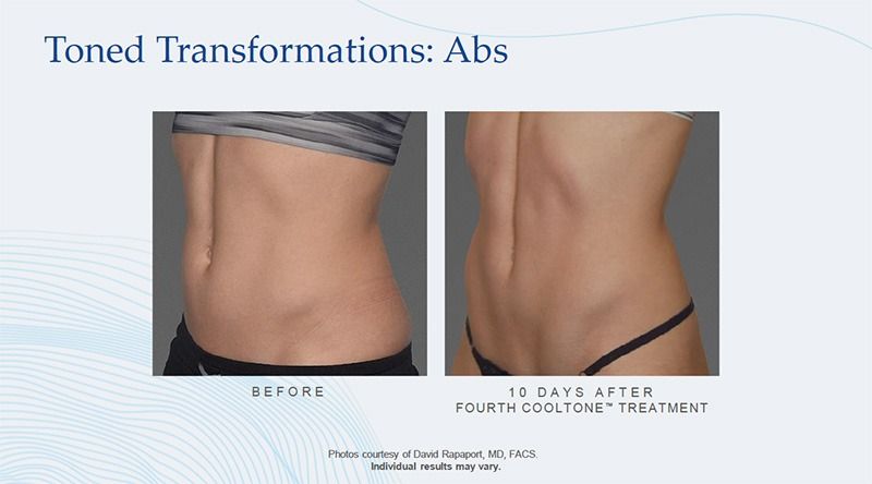 cooltone patient before and after treatment - abdomen