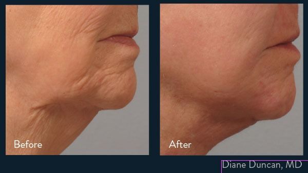 patient at barber facial plastic surgery before and after facetite skin tightening procedure mobile alabama