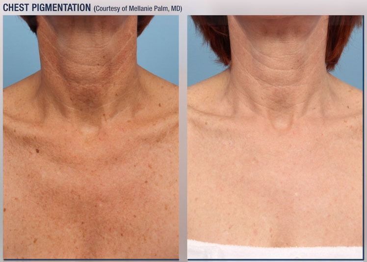 patient at barber facial plastic surgery before and after photofractional laser treatment for chest pigmentation