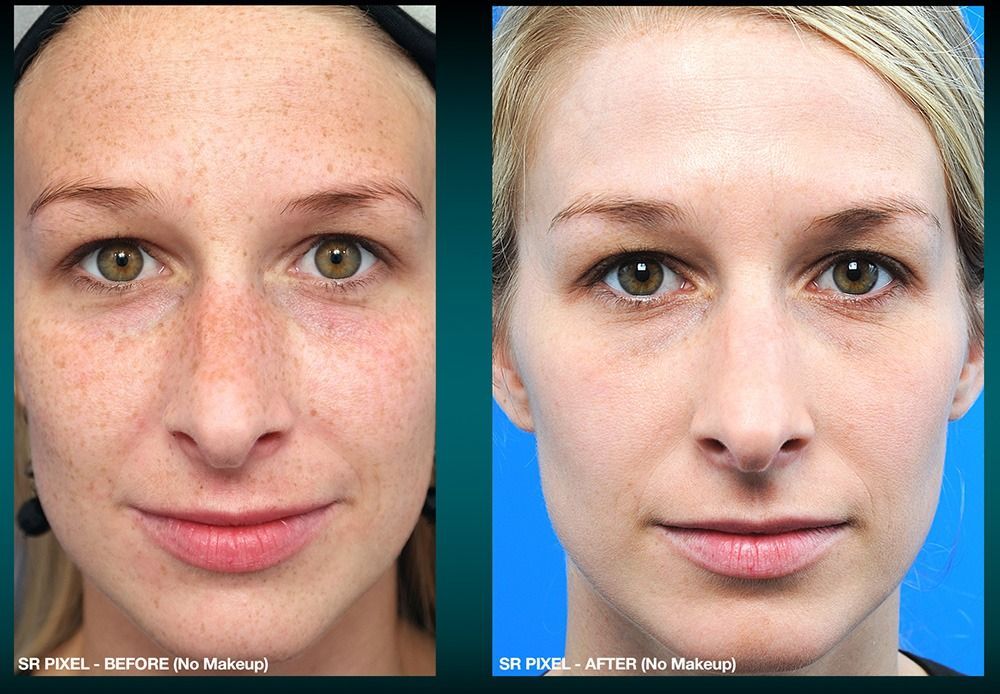 patient at barber facial plastic surgery before and after IPL laser for brpwn spots