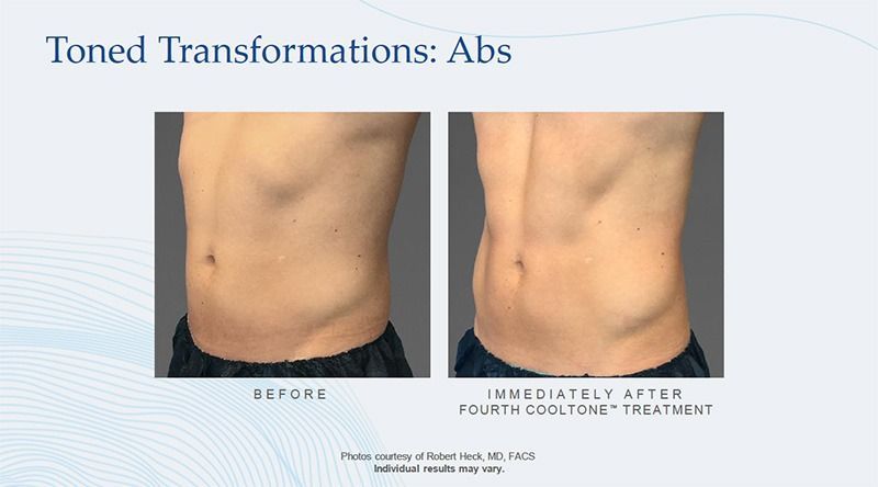 cooltone patient before and after treatment - abdomen