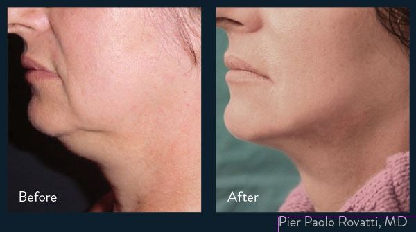 patient at barber facial plastic surgery before and after facetite skin tightening procedure mobile alabama