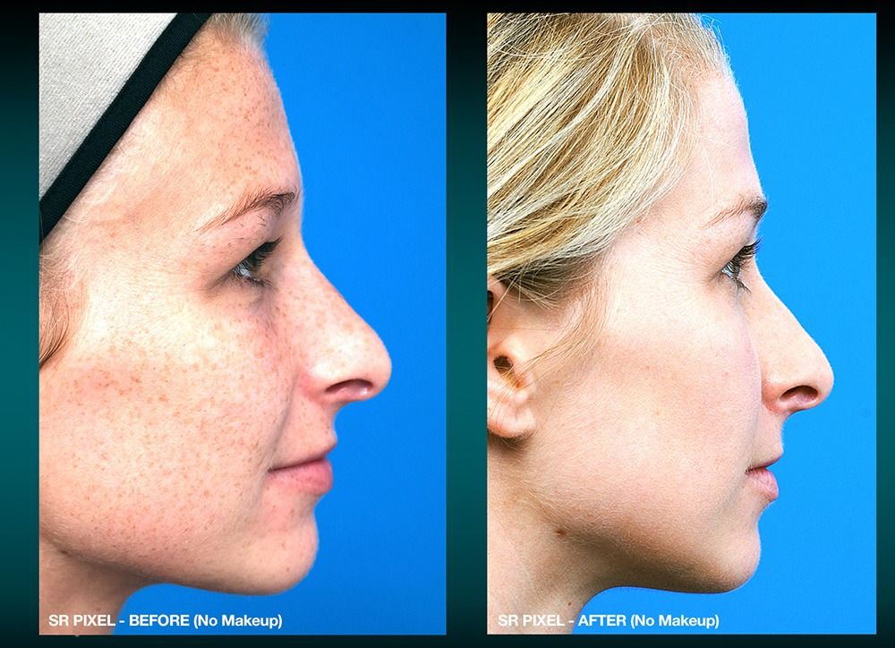 patient at barber facial plastic surgery before and after IPL laser for brpwn spots