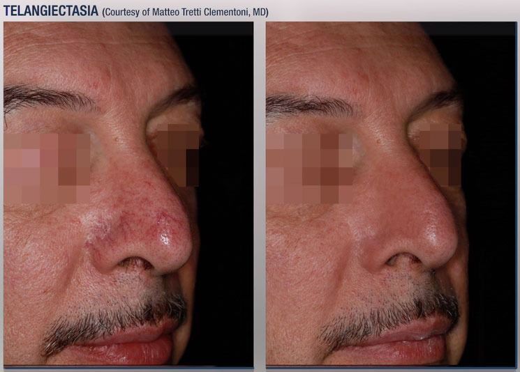 patient at barber facial plastic surgery before and after photofractional laser treatment for telangiecstasia