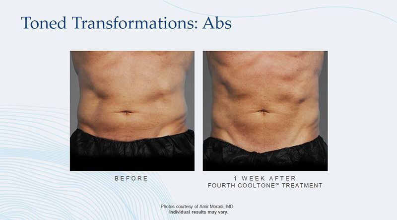 cooltone patient before and after treatment - abdomen