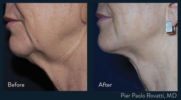 patient at barber facial plastic surgery before and after facetite skin tightening procedure mobile alabama