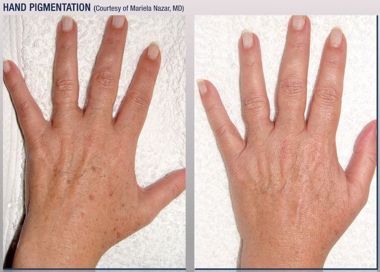 patient at barber facial plastic surgery before and after photofractional laser treatment for hands