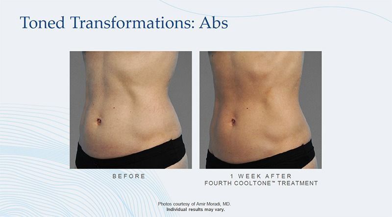 cooltone patient before and after treatment - abdomen