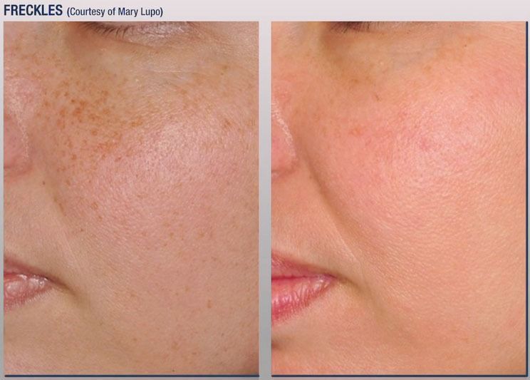 patient at barber facial plastic surgery before and after photofractional laser treatment for freckles