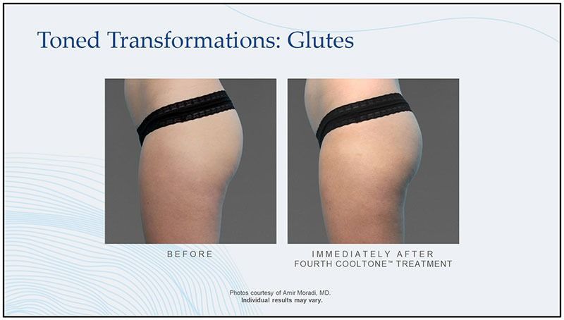 cooltone patient before and after treatment - glutes