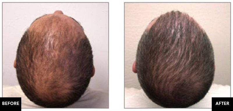 patient before and after neograft hair restoration treatment mobile al